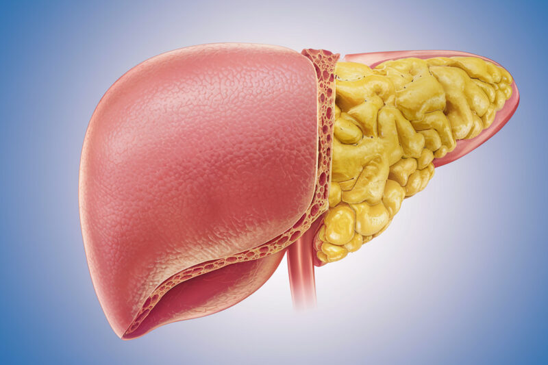 Liver Fat Explained: What It Is, Why You Have It, and How to Burn It