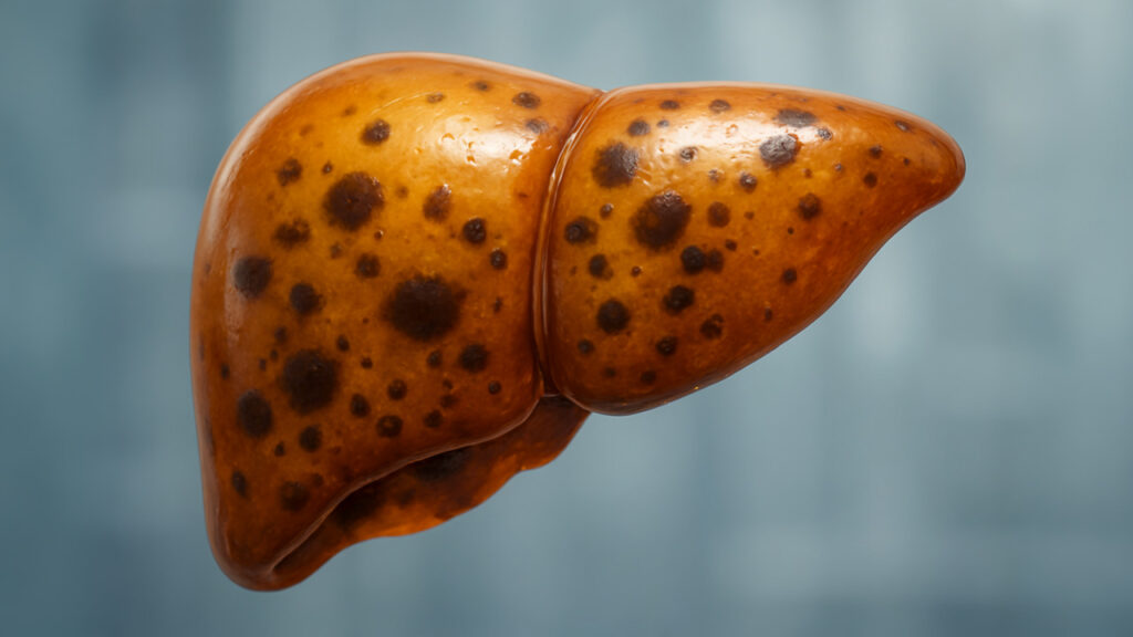Are Toxins Making You Fat? What Your Liver Is Telling You