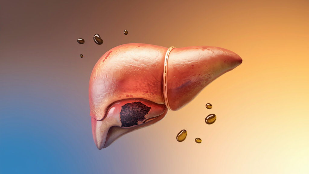 Liver Overload: What Causes It and How to Reverse It