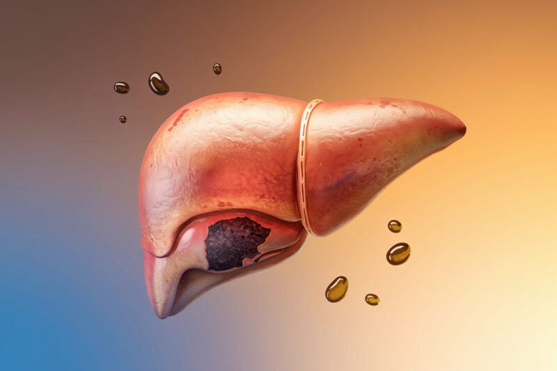 Liver Overload: What Causes It and How to Reverse It