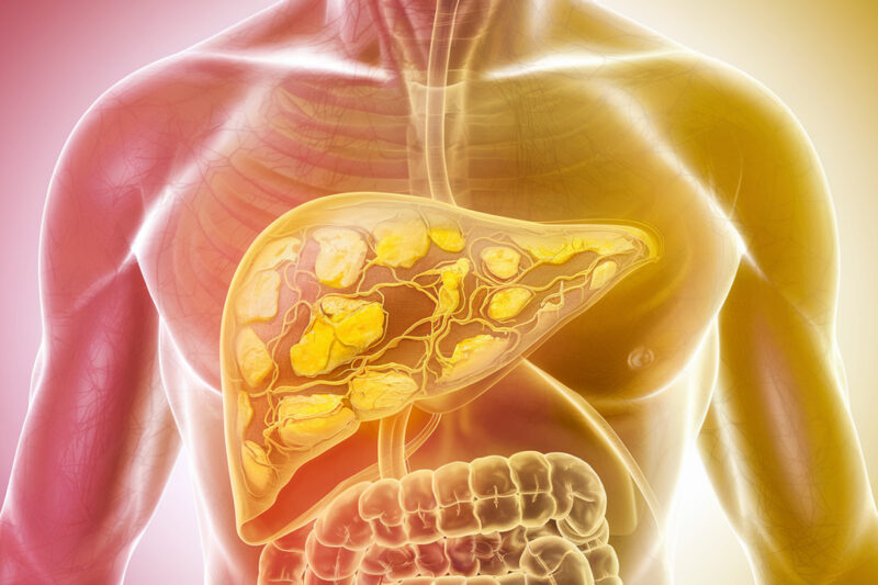 What You Should Know About Non-Alcoholic Fatty Liver and Weight Gain