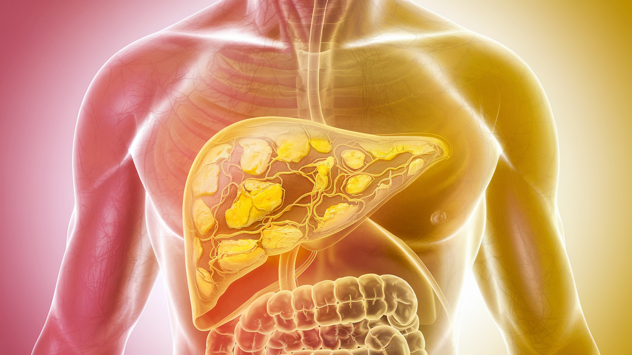 What You Should Know About Non-Alcoholic Fatty Liver and Weight Gain